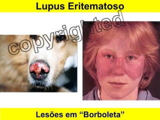 Lupus Eritematoso Lesões em “Borboleta” 