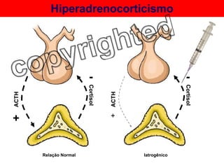Hiperadrenocorticismo Iatrogênico Relação Normal ACTH + Cortisol - ACTH + Cortisol - 