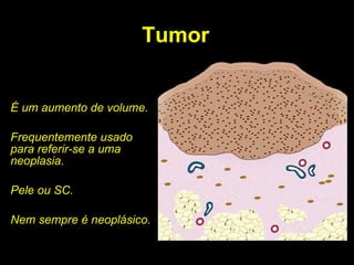 Tumor É um aumento de volume. Frequentemente usado para referir-se a uma neoplasia. Pele ou SC. Nem sempre é neoplásico. 