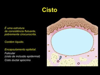 Cisto É uma estrutura de consistência flutuante, pobremente cirscunscrita. Contém líquido. Encapsulamento epitelial. Folicular (cisto de inclusão epidermal) Cisto ductal apócrino 