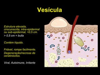 Vesícula Estrutura elevada, cirscunscrita, intra-epidermal ou sub-epidermal, <0,5 cm. > 0,5 cm = bulla Contém líquido. Friável, rompe facilmente. Degeneração/necrose de ceratinócitos. Viral, Autoimune, Irritante 