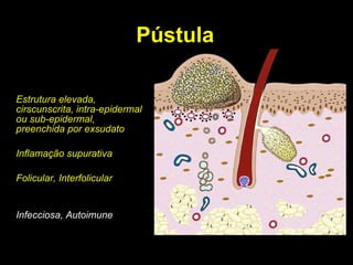 Pústula Estrutura elevada, cirscunscrita, intra-epidermal ou sub-epidermal, preenchida por exsudato Inflamação supurativa Folicular, Interfolicular Infecciosa, Autoimune 