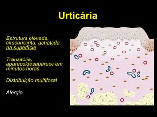 Urticária Estrutura elevada, cirscunscrita,  achatada na superfície Transitória, aparece/desaparece em minutos-horas Distribuição multifocal Alergia 