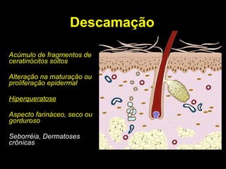 Descamação Acúmulo de fragmentos de ceratinócitos soltos Alteração na maturação ou proliferação epidermal Hiperqueratose Aspecto farináceo, seco ou gorduroso Seborréia, Dermatoses crônicas 