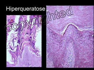 Hiperqueratose 