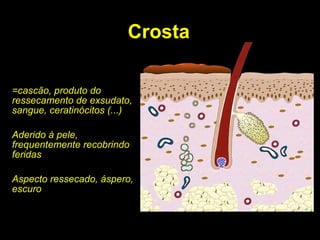 Crosta =cascão, produto do ressecamento de exsudato, sangue, ceratinócitos (...) Aderido à pele, frequentemente recobrindo feridas Aspecto ressecado, áspero, escuro 