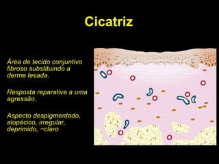 Cicatriz Área de tecido conjuntivo fibroso substituindo a derme lesada. Resposta reparativa a uma agressão. Aspecto despigmentado, alopécico, irregular, deprimido, ~claro 