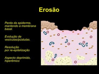 Erosão Perda da epiderme, mantendo a membrana basal. Evolução de vesículas/pústulas. Resolução por re-epitelização Aspecto deprimido, hiperêmico 