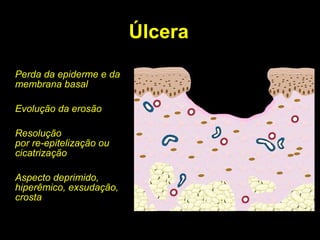 Úlcera Perda da epiderme e da membrana basal Evolução da erosão Resolução por re-epitelização ou cicatrização Aspecto deprimido, hiperêmico, exsudação, crosta 