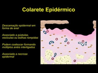 Colarete Epidérmico Descamação epidermal em forma de anel Associado a pústulas, vesículas ou bolhas rompidas Podem coalescer formando múltiplos anéis interligados Associada a necrose epidermal 