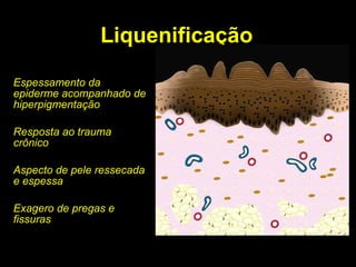 Liquenificação Espessamento da epiderme acompanhado de hiperpigmentação Resposta ao trauma crônico Aspecto de pele ressecada e espessa Exagero de pregas e fissuras 