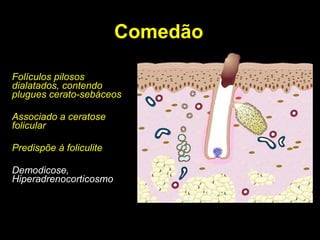 Comedão Folículos pilosos dialatados, contendo plugues cerato-sebáceos Associado a ceratose folicular Predispõe à foliculite Demodicose, Hiperadrenocorticosmo 