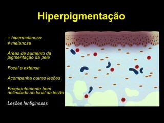 Hiperpigmentação = hipermelanose ≠  melanose Áreas de aumento da pigmentação da pele Focal a extensa Acompanha outras lesões Frequentemente bem delimitada ao local da lesão Lesões lentiginosas 