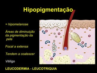 Hipopigmentação = hipomelanose Áreas de diminuição  da pigmentação da pele Focal a extensa Tendem a coalescer Vitiligo LEUCODERMIA - LEUCOTRIQUIA 