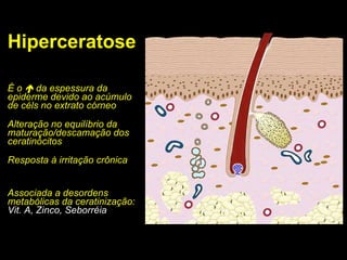 Hiperceratose É o    da espessura da epiderme devido ao acúmulo de céls no extrato córneo Alteração no equilíbrio da maturação/descamação dos ceratinócitos Resposta à irritação crônica Associada a desordens metabólicas da ceratinização: Vit. A, Zinco, Seborréia 