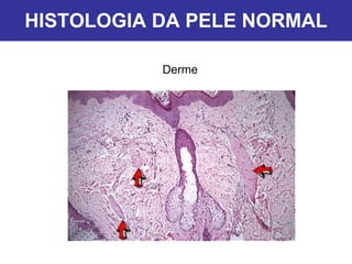 HISTOLOGIA DA PELE NORMAL Derme 