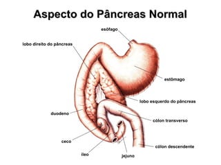 Aspecto do Pâncreas Normal esôfago estômago lobo direito do pâncreas lobo esquerdo do pâncreas duodeno ceco íleo jejuno cólon descendente cólon transverso 