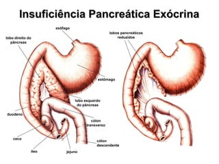 Insuficiência Pancreática Exócrina lobos pancreáticos reduzidos esôfago estômago lobo direito do pâncreas lobo esquerdo do pâncreas duodeno ceco íleo jejuno cólon descendente cólon transverso 
