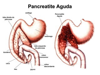 Pancreatite Aguda Pancreatite Aguda esôfago estômago lobo direito do pâncreas lobo esquerdo do pâncreas duodeno ceco íleo jejuno cólon descendente cólon transverso 