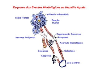 Trato Portal Infiltrado Inflamatório Reação Ductal Necrose Periportal Esteatose Degeneração Balonosa Apoptose Acúmulo Macrofágico Veia Central Colestase Apoptose Esquema dos Eventos Morfológicos na Hepatite Aguda 