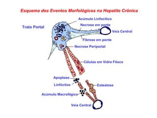 Apoptose Linfócitos Acúmulo Linfocítico Necrose em ponte Fibrose em ponte Veia Central Veia Central Necrose Periportal Células em Vidro Fôsco Esteatose Acúmulo Macrofágico Trato Portal Esquema dos Eventos Morfológicos na Hepatite Crônica 