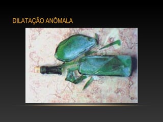 DILATAÇÃO ANÔMALA
 