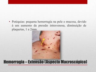 Hemorragia – Extensão (Aspecto Macroscópico)
• Petéquias: pequena hemorragia na pele e mucosa, devido
à um aumento da pressão intravenosa, diminuição de
plaquetas, 1 a 2mm.
 