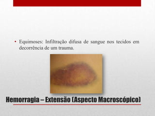 Hemorragia – Extensão (Aspecto Macroscópico)
• Equimoses: Infiltração difusa de sangue nos tecidos em
decorrência de um trauma.
 