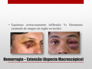 Hemorragia – Extensão (Aspecto Macroscópico)
• Equimose (extravasamento infiltrado) Vs Hematoma
(acúmulo de sangue em órgão ou tecido)
 