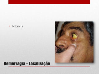 Hemorragia – Localização
• Icterícia
 