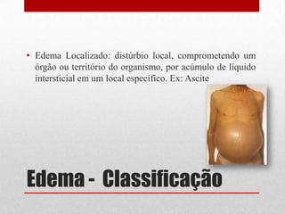 Edema - Classificação
• Edema Localizado: distúrbio local, comprometendo um
órgão ou território do organismo, por acúmulo de líquido
intersticial em um local específico. Ex: Ascite
 