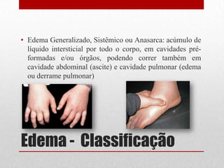 Edema - Classificação
• Edema Generalizado, Sistêmico ou Anasarca: acúmulo de
líquido intersticial por todo o corpo, em cavidades pré-
formadas e/ou órgãos, podendo correr também em
cavidade abdominal (ascite) e cavidade pulmonar (edema
ou derrame pulmonar)
 