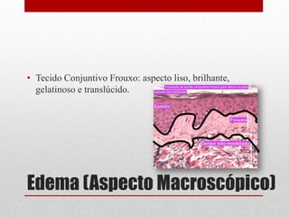 Edema (Aspecto Macroscópico)
• Tecido Conjuntivo Frouxo: aspecto liso, brilhante,
gelatinoso e translúcido.
 
