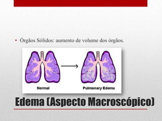 Edema (Aspecto Macroscópico)
• Órgãos Sólidos: aumento de volume dos órgãos.
 