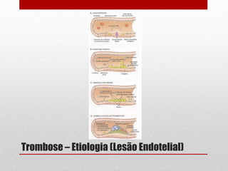 Trombose – Etiologia (Lesão Endotelial)
 