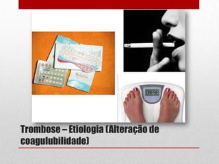 Trombose – Etiologia (Alteração de
coagulubilidade)
 