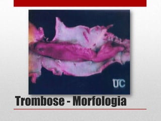 Trombose - Morfologia
 