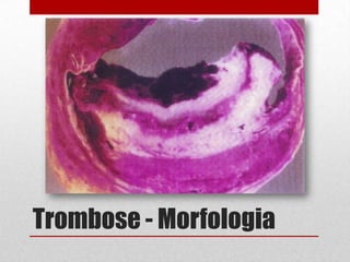 Trombose - Morfologia
 