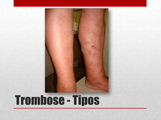 Trombose - Tipos
 
