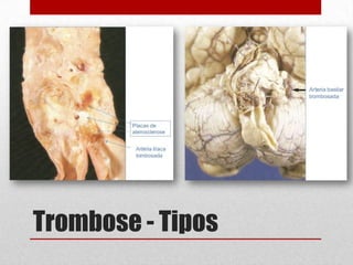 Trombose - Tipos
 
