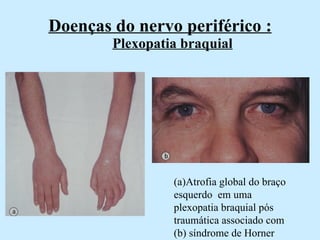 Doenças do nervo periférico :   Plexopatia braquial (a)Atrofia global do braço esquerdo  em uma plexopatia braquial pós traumática associado com (b) síndrome de Horner  