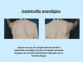 Amiotrofia neurálgica   Aspecto em asa da escápula direita devido à amiotrofia neurálgica do plexo braquial causando fraqueza do serrátil anterior(inervado pelo nervo torácico longo) 