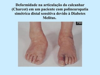 Deformidade na articulação do calcanhar (Charcot) em um paciente com polineuropatia simétrica distal sensitiva devido à Diabetes Melitus.   
