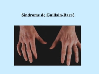 Síndrome de Guillain-Barré   