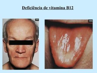 Deficiência de vitamina B12 