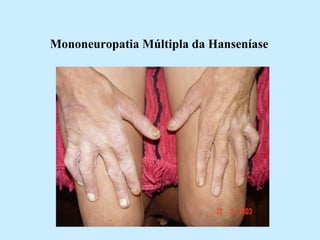 Mononeuropatia Múltipla da Hanseníase   