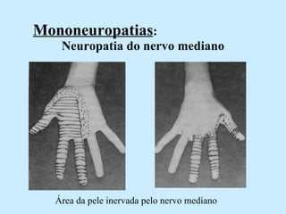 Mononeuropatias :  Neuropatia do nervo mediano Área da pele inervada pelo nervo mediano 