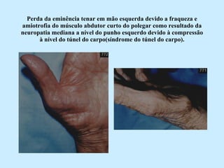 Perda da eminência tenar em mão esquerda devido a fraqueza e amiotrofia do músculo abdutor curto do polegar como resultado da neuropatia mediana a nível do punho esquerdo devido à compressão à nível do túnel do carpo(síndrome do túnel do carpo). 