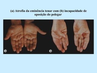 (a) Atrofia da eminência tenar com (b) incapacidade de oposição do polegar   