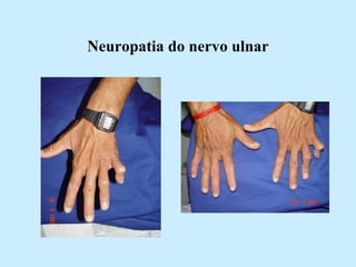 Neuropatia do nervo ulnar 